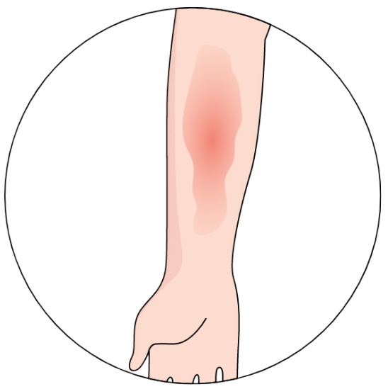 EGZEMA - ATOPOWE ZAPALENIE SKÓRY